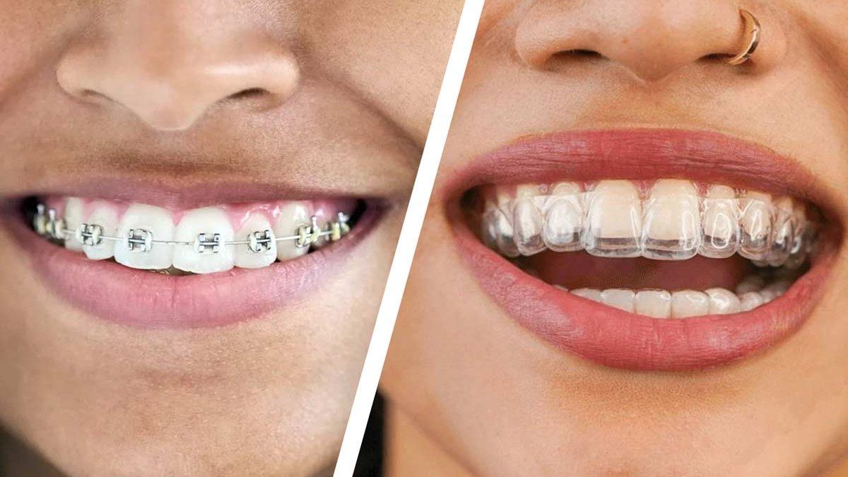 Braces vs. Aligners: Which One Is Actually Right for You?