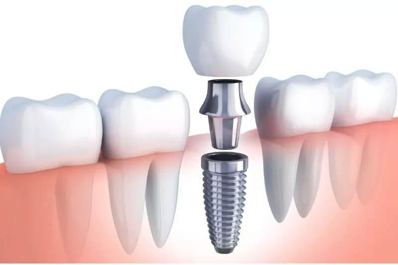 Thinking About Dental Implants? Here's What to Know Before You Decide