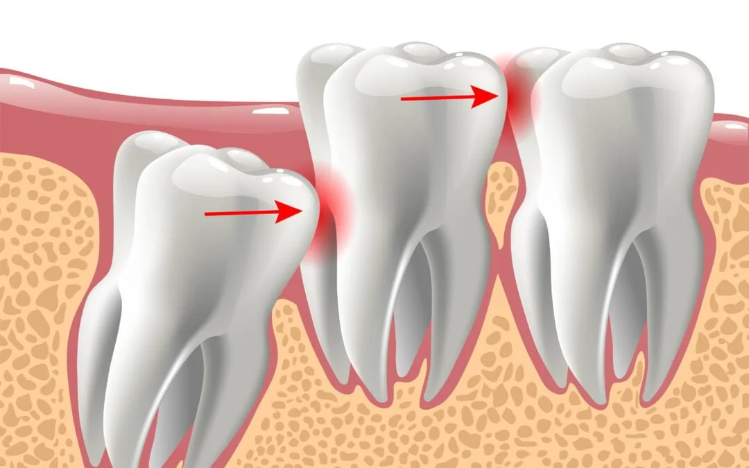 Is Your Wisdom Tooth Actually a Problem? A Gurugram Dentist Explains