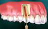 Root Canal Specialist in Gurgaon